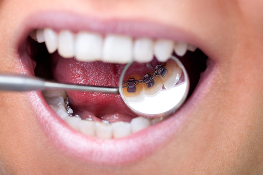 矯正歯科治療の種類・料金 - つだ歯科矯正歯科（綾瀬市）