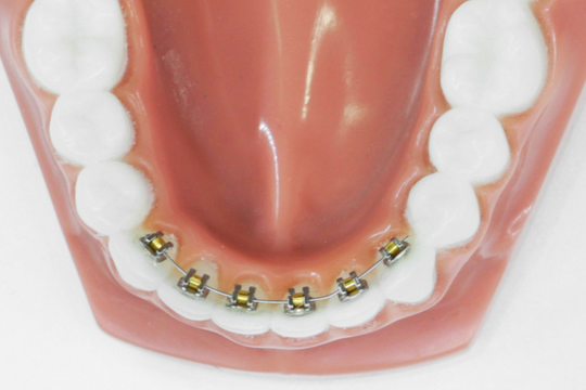 矯正歯科治療の種類・料金 - つだ歯科矯正歯科（綾瀬市）